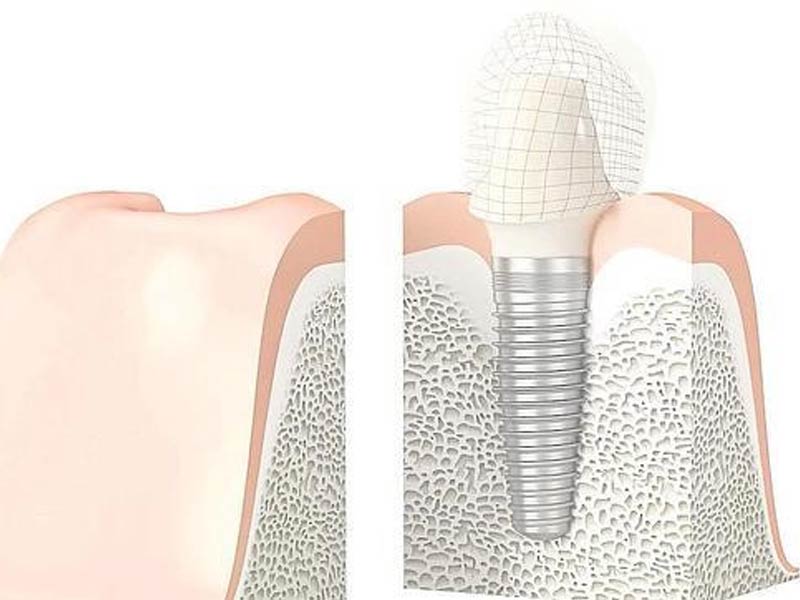 Sonrisa natural, el último reto de los implantes dentales