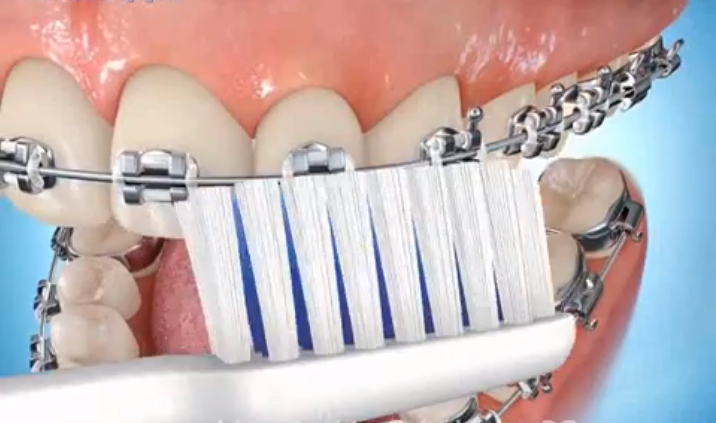 higiene dental con ortodoncia