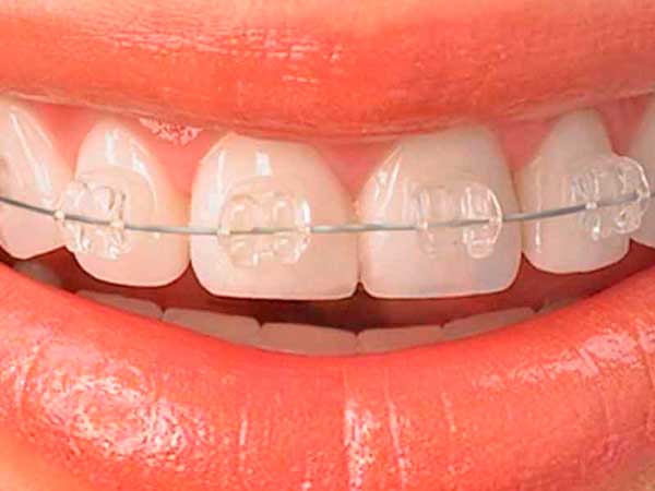 Qué son los brackets estéticos