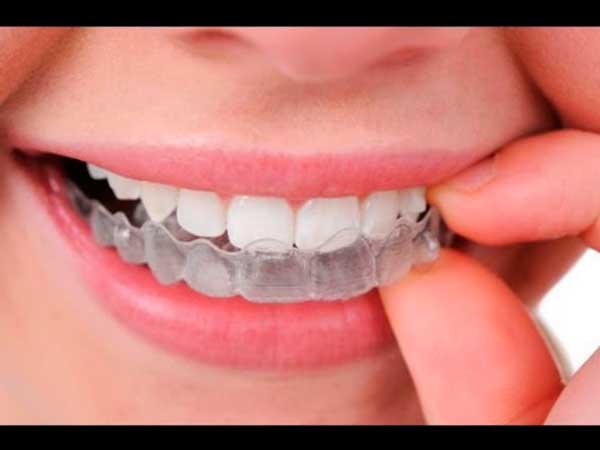 ortodoncia transparente Invisalign
