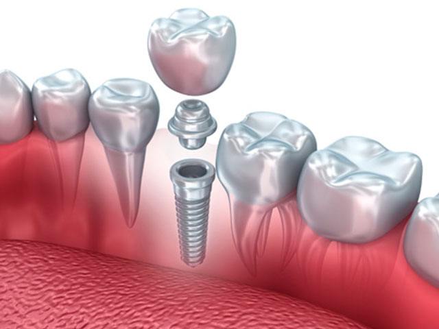 Tipos de implante dental 