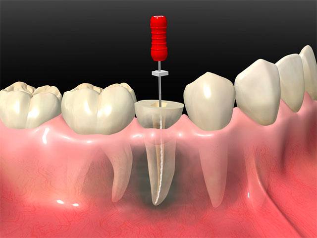 Endodoncia en diente. 