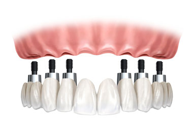 implantes dentales chamberí