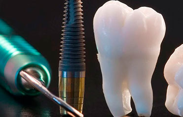 Implantología Dental Madrid Centro
